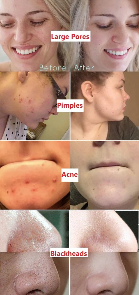 قناع الشاي الأخضر - الصورة 5